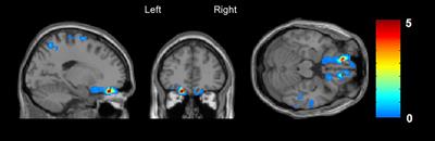 Trapped in a Glass Bell Jar: Neural Correlates of Depersonalization and Derealization in Subjects at Clinical High-Risk of Psychosis and Depersonalization–Derealization Disorder